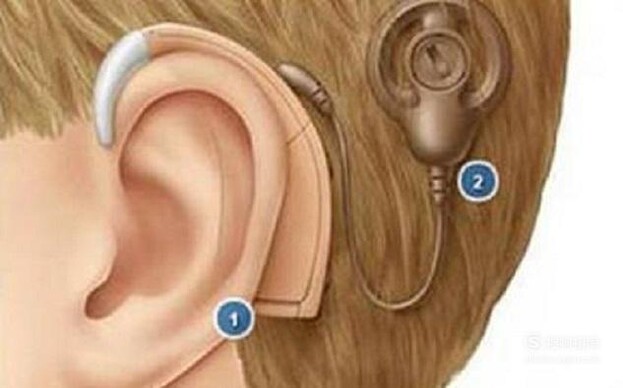 佩戴人工耳蜗对身体有哪些危害