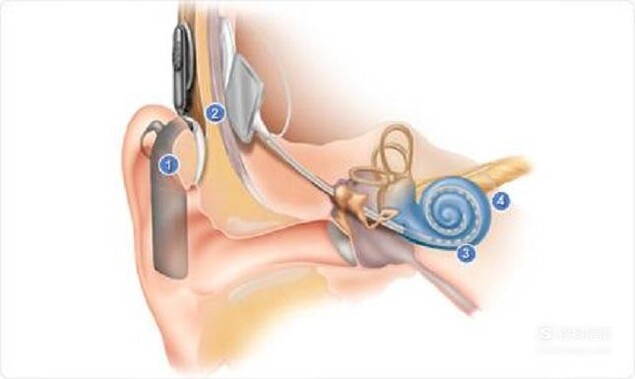 佩戴人工耳蜗对身体有哪些危害